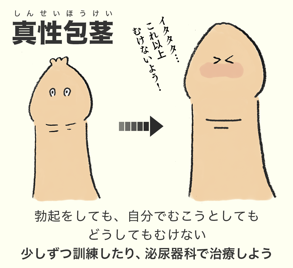 包茎 仮性包茎 真性包茎 カントン包茎 皮 剥けない 手術 セイシル